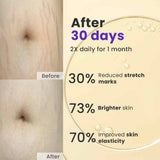 Anti Stretch Marks Oil