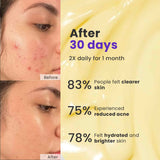 Acne Erase Cream