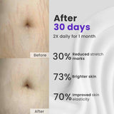Anti Stretch Marks Cream