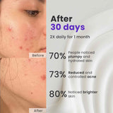 Acne Shield Moisturizer
